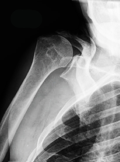 View of the glenohumeral joint demonstrating superior migration of the humeral head subsequent to rotator cuff tear.